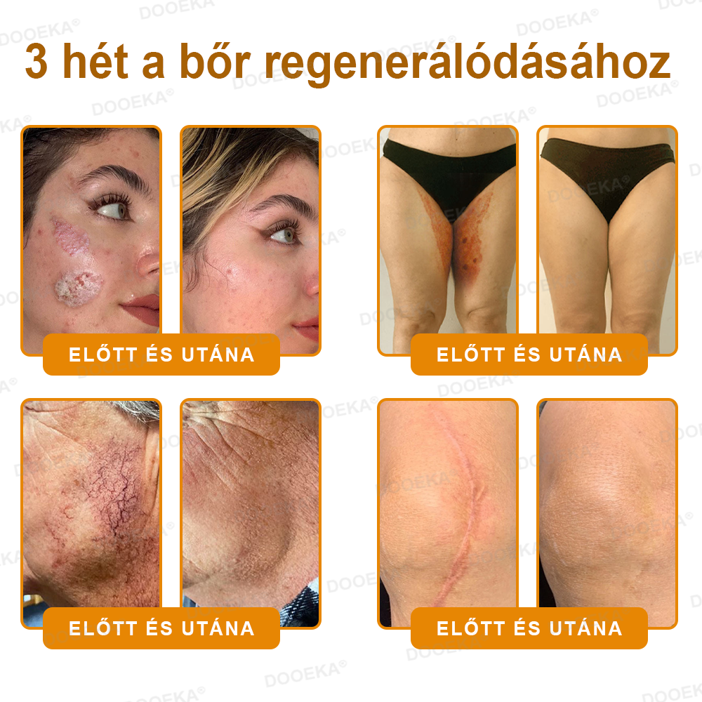 🌿 OGYÉI által jóváhagyva: DOOEKA® Méhméreg Bőrmegújító Krém — 🔥Korlátozott ideig 80% kedvezmény🔥