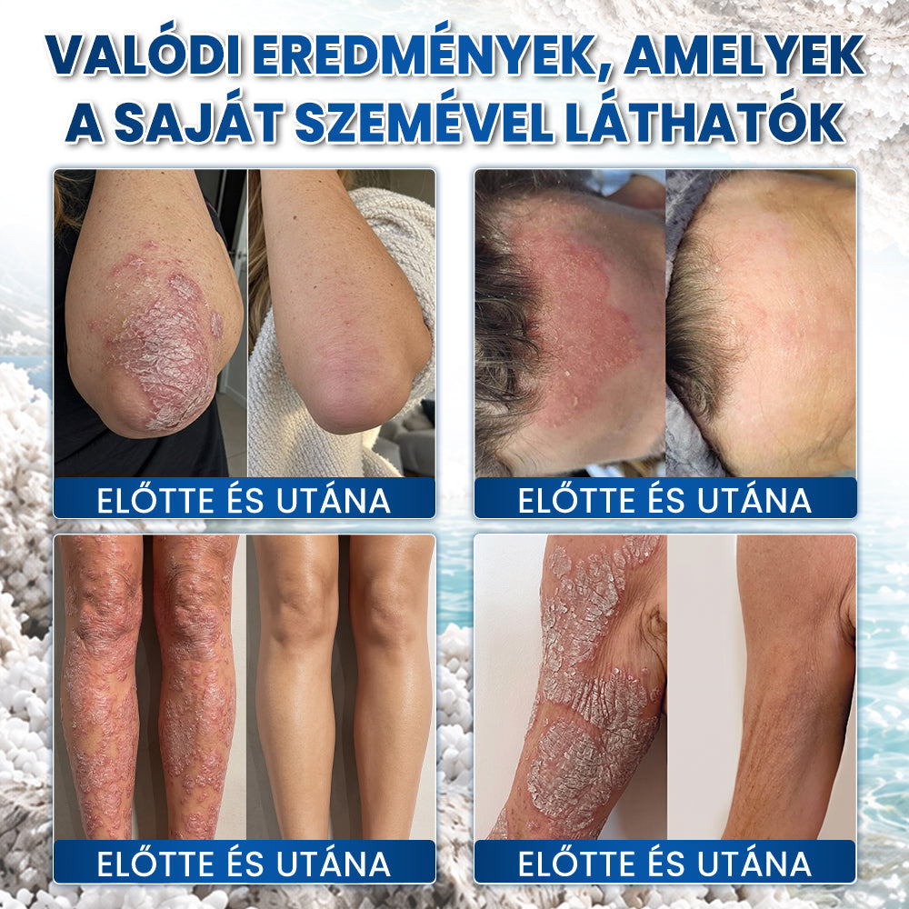 Medistart® PSZORIÁZIS SPECIÁLIS BŐRÁPOLÓ 💙