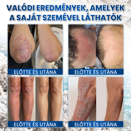 Medistart® PSZORIÁZIS SPECIÁLIS BŐRÁPOLÓ 💙