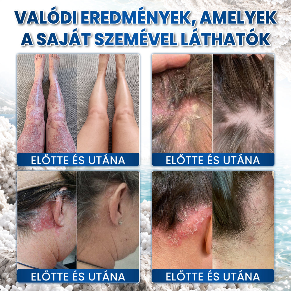 Medistart® PSZORIÁZIS SPECIÁLIS BŐRÁPOLÓ 💙