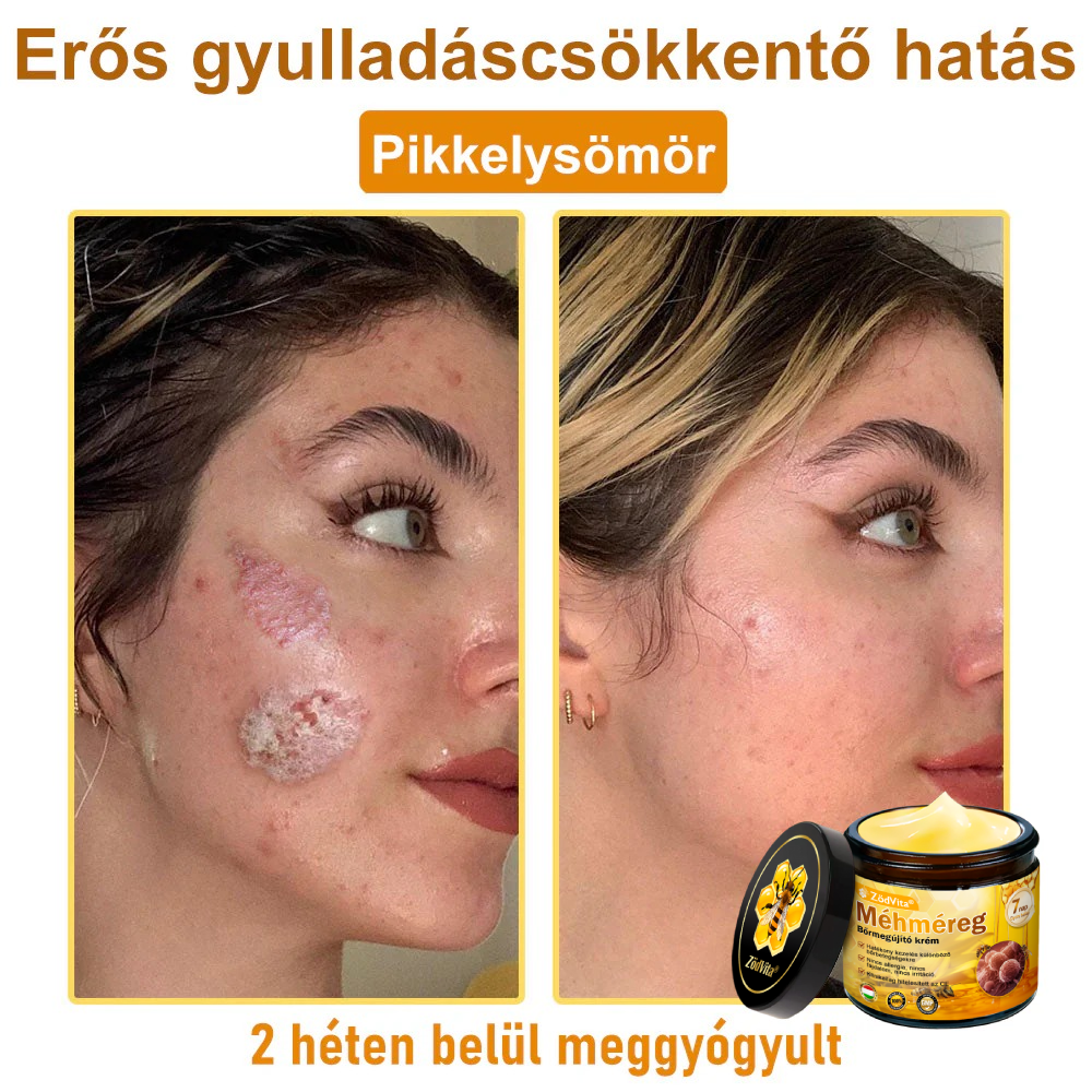 🐝🌿 ZödVita® Méhméreg Bőr Helyreállító Krém (👨‍⚕‍CE Tanúsítvány)👍✅