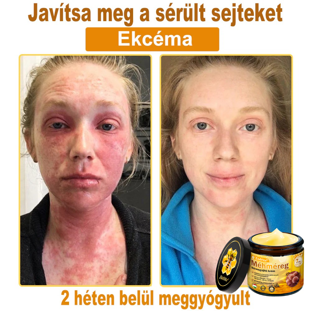 🐝🌸 Bőrgyógyász ajánlása ✨ ZödVita® Méhméreg Bőr Helyreállító Krém 🔥 Magyar fejlesztés, magyarországi gyártás és szállítás