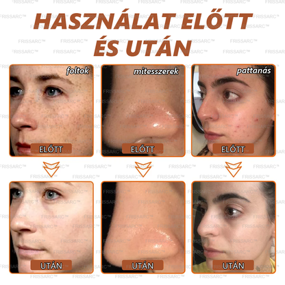 (40%-60% kedvezmény élvezete) 𝐅𝐑𝐈𝐒𝐒𝐀𝐑𝐂™ Fehérítő És Folteltávolító Arcmaszk - Természetes összetevők tartósan eltüntetik a foltokat, szeplőket és napfoltokat.