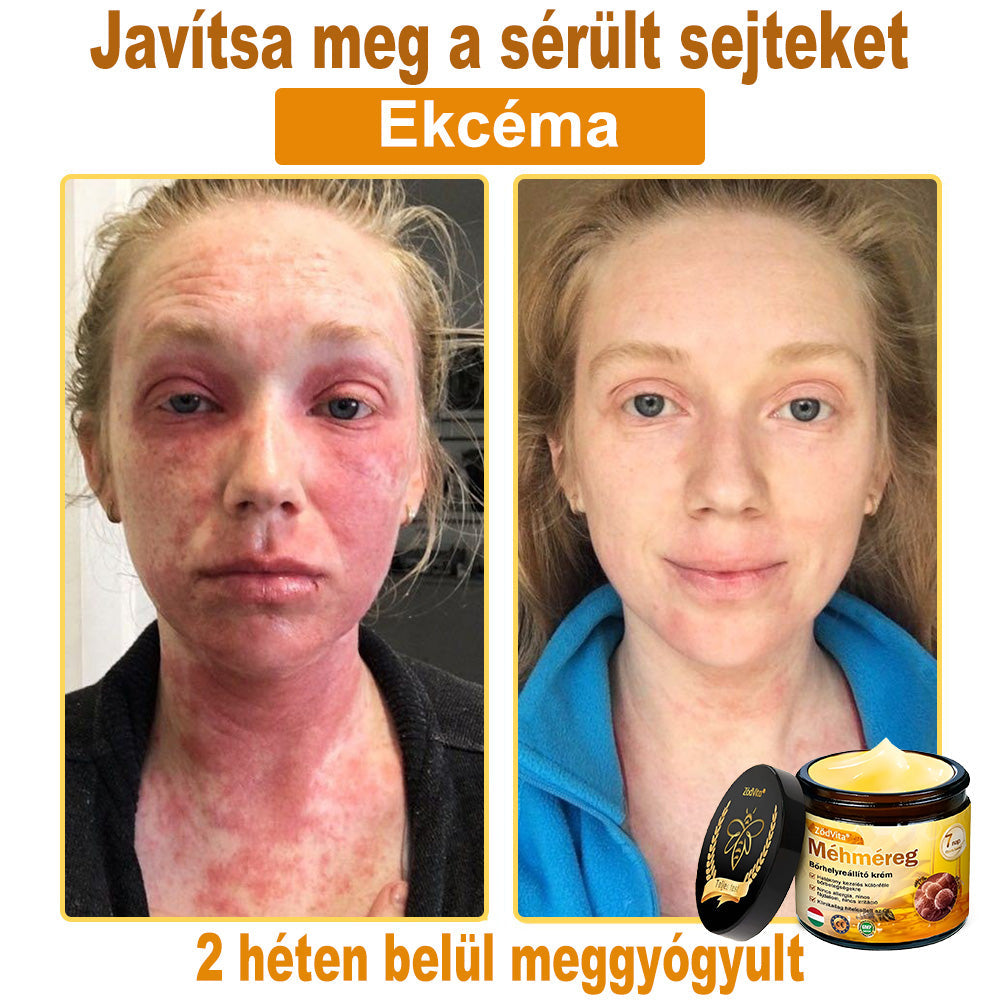 ⭐⭐ ZödVita® Méhméreg Bőr Helyreállító Krém (👨‍⚕‍CE jóváhagyott)👍✅