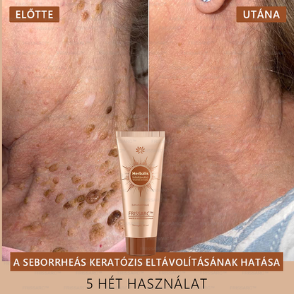 (40%-60% kedvezmény élvezete) 𝐅𝐑𝐈𝐒𝐒𝐀𝐑𝐂™ Fehérítő És Folteltávolító Arcmaszk - Természetes összetevők tartósan eltüntetik a foltokat, szeplőket és napfoltokat.