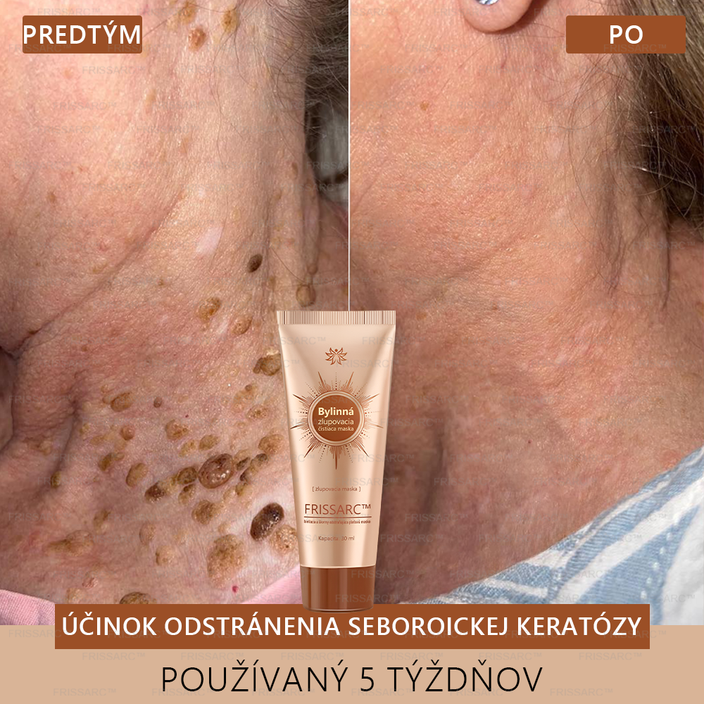 💟FRISSARC™ bieliaca a škvrny odstraňujúca pleťová maska –🍀Prírodné zložky trvalo odstraňujú pigmentové škvrny, starecké škvrny, pehy a slnečné škvrny.