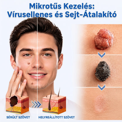✨ PuraCure® 2 az 1-ben mikrotűs és hidrokolloid tapasz🍀 | Kiálló anyajegyek, aknék, lapos szemölcsök és bőrnövedékek eltávolítására | Segít csökkenteni a ráncokat, hegeket és bőrhibákat | Láthatatlan tapasz az arcra és testre