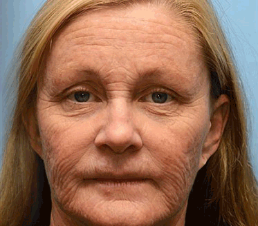 FrissArc™ Botox Méhméreg Ránctalanító Krém, Kétszeres hatású anti-aging krém